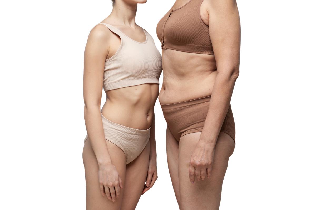 A patient’s arm liposuction results illustrating toned and defined upper arms after a successful body sculpting procedure.