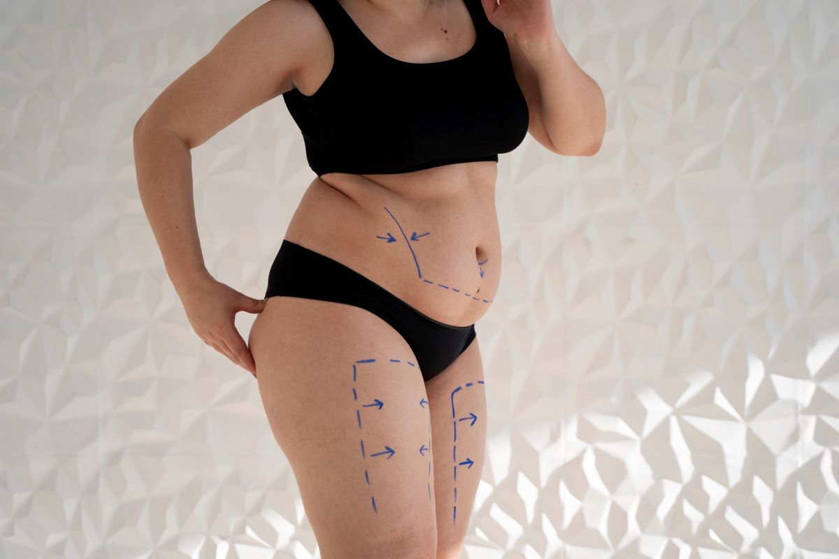 Before and after results of stomach liposuction, showcasing a flatter, more defined abdomen.