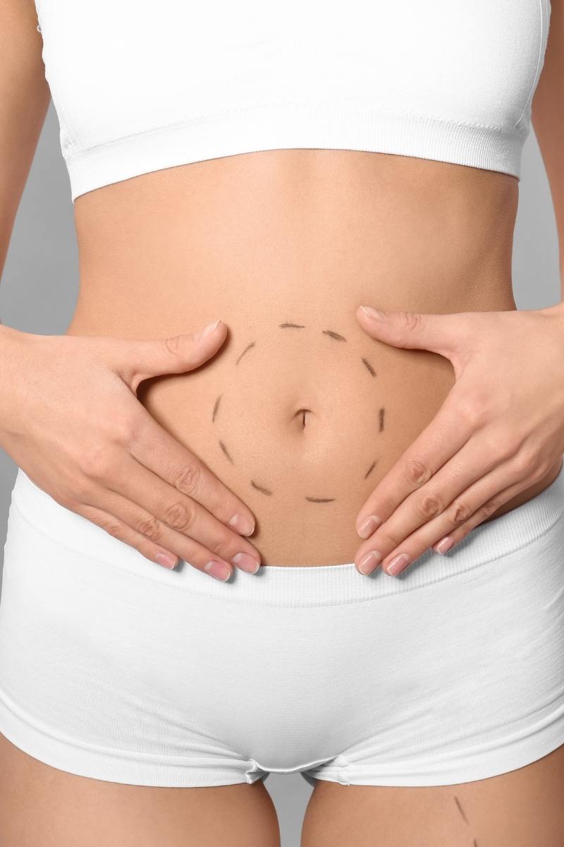 Dr. Ulaş Bali performing mommy makeover surgery, combining advanced techniques to restore a woman’s pre-pregnancy body shape and confidence.