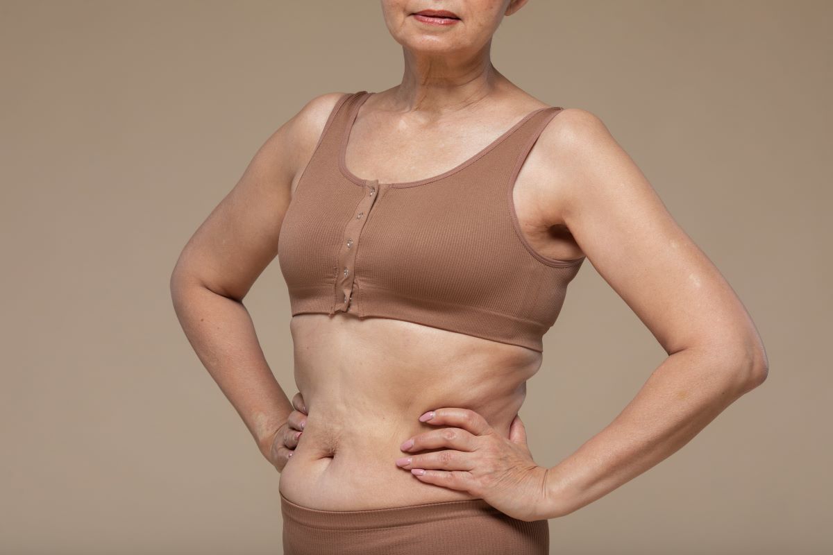 Post-surgery results of a mommy makeover, highlighting a sculpted waistline and balanced body contours.