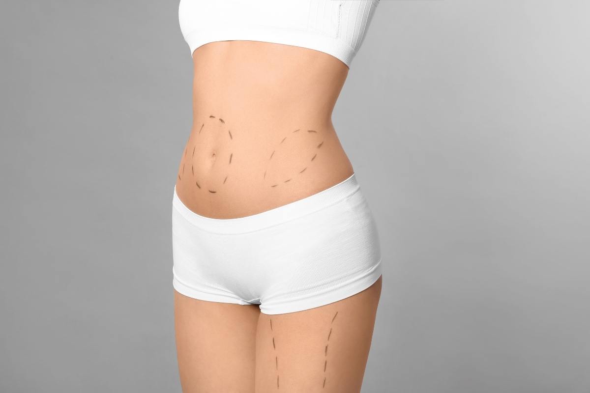 Dr. Ulaş Bali performing a tummy tuck as part of a customized mommy makeover procedure.