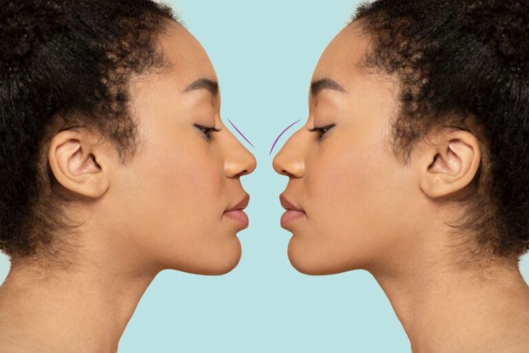 Dr. Ulas Bali performing rhinoplasty surgery with precision, focusing on both cosmetic and functional improvements to the nose.