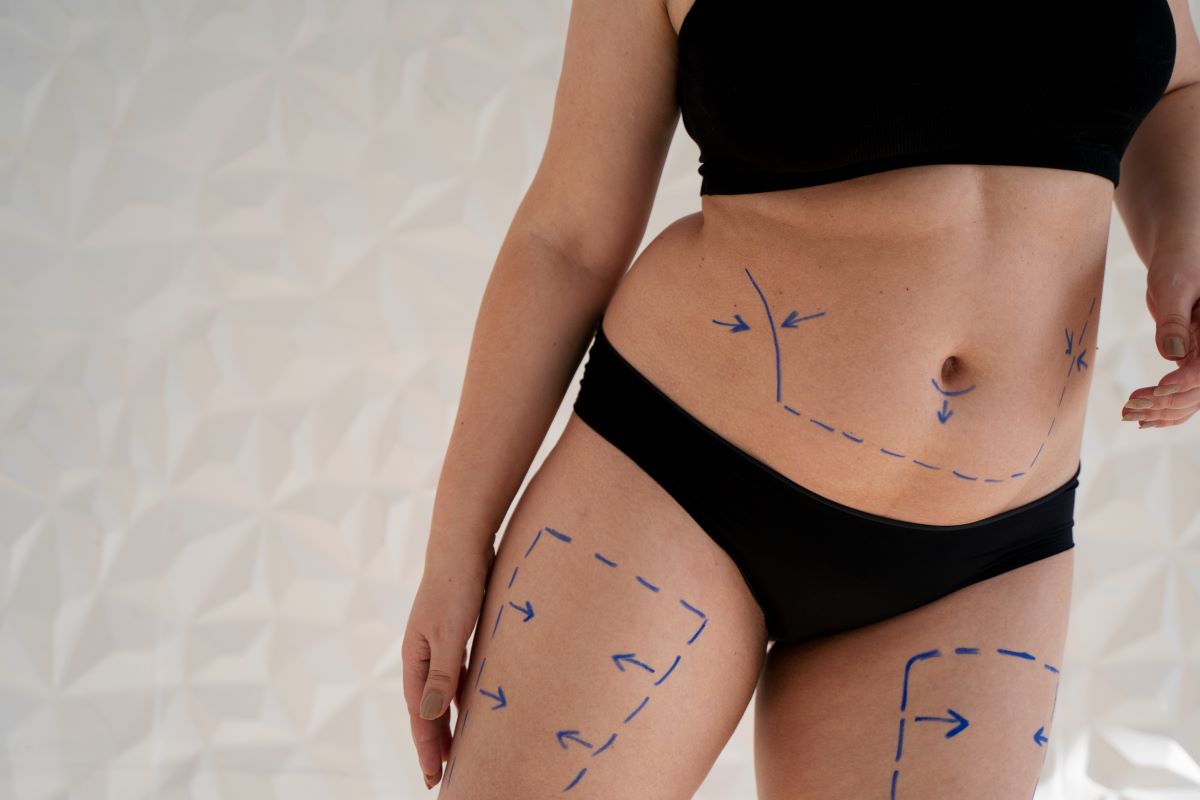 Illustration of tummy tuck results showing a firmer abdominal contour.