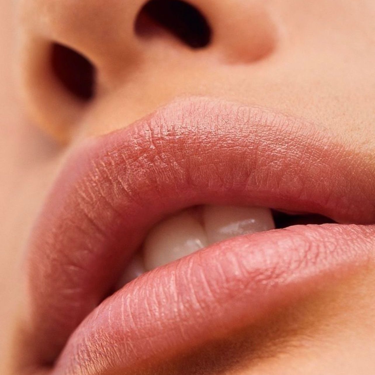 Dr. Ulaş Bali enhancing lip volume and shape with lip augmentation for a fuller, natural, and beautifully defined appearance.