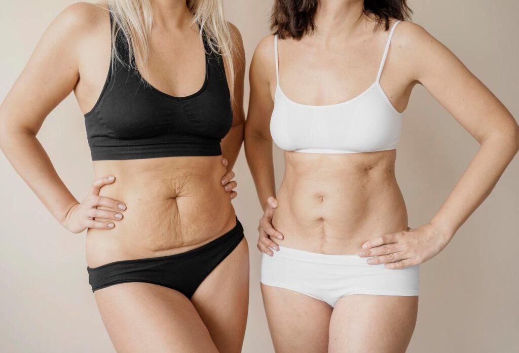 Comparison of liposuction before and after results as part of a mommy makeover transformation, showcasing advanced techniques in 2025.
