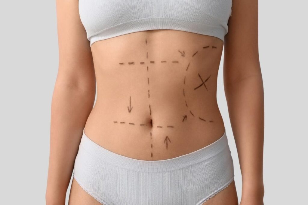 Before and after results of a mommy makeover showing a restored body contour.