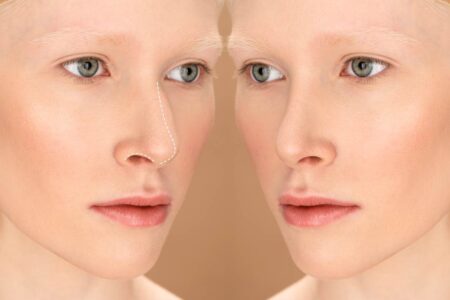 Before and after results of ethnic rhinoplasty, showcasing natural enhancements while maintaining unique facial features.