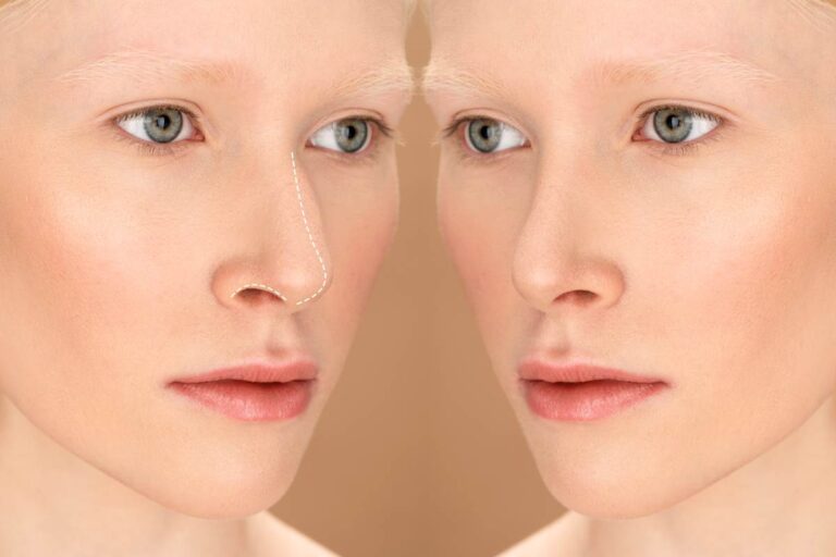 Before and after results of ethnic rhinoplasty, showcasing natural enhancements while maintaining unique facial features.
