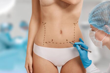 Before and after images of liposuction, showcasing body contouring transformation.