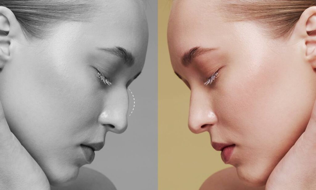 Before and after rhinoplasty transformation showing profile improvement.