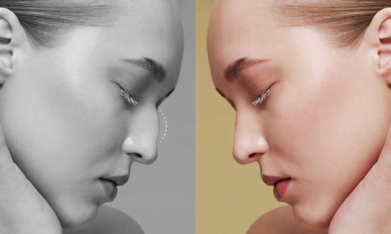 Before and after rhinoplasty transformation showing profile improvement.