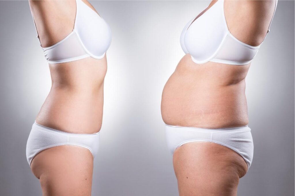 Smooth, contoured female waistline showcasing Liposuction 360 results.