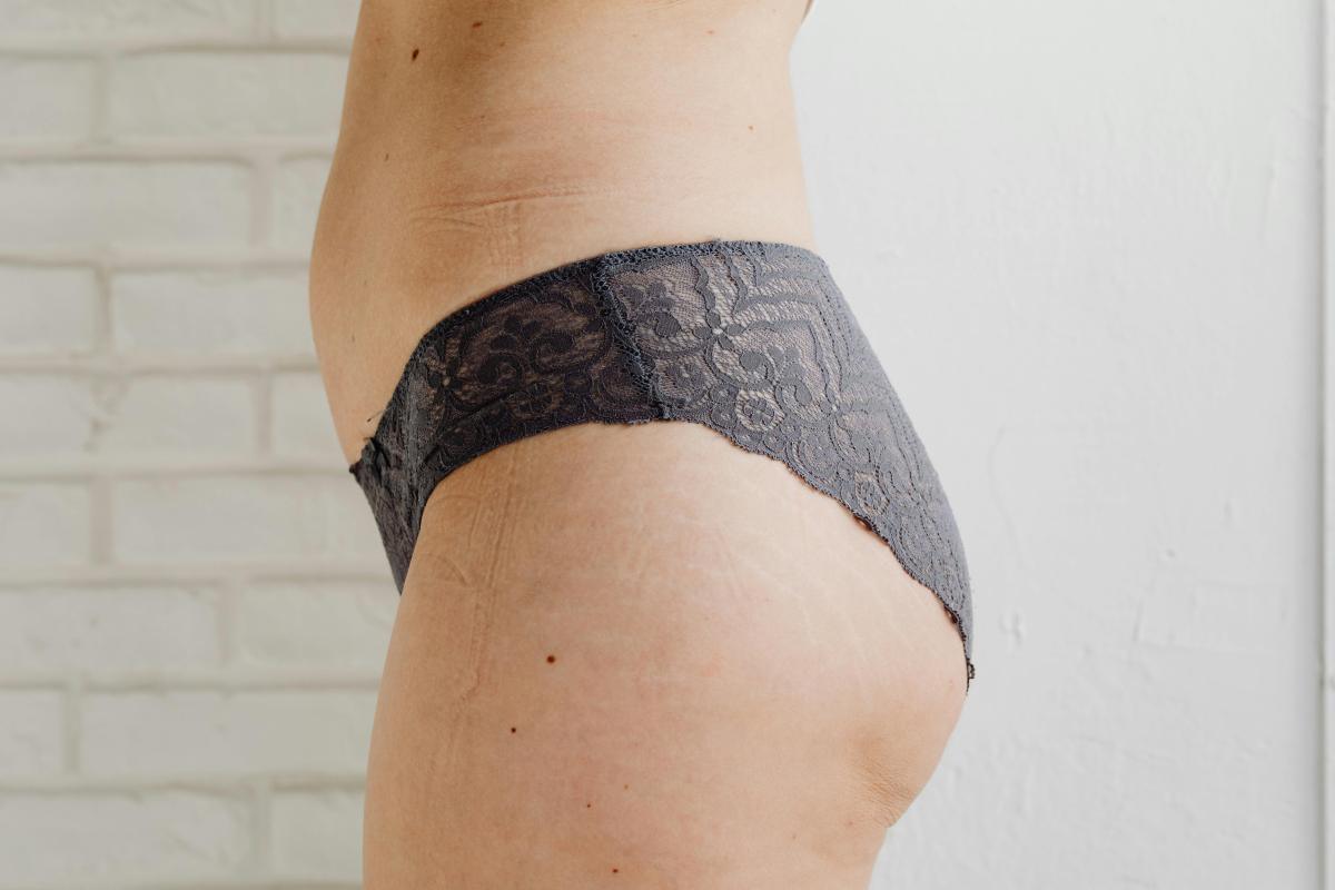 Before and after silhouette illustration of a mommy makeover transformation showing tummy tuck and breast lift results.