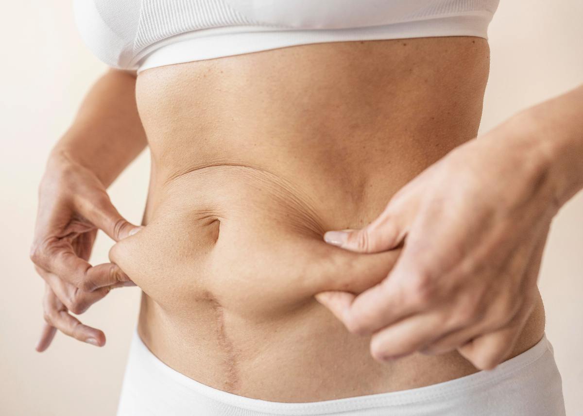 Post-surgery results showing toned abdomen and lifted breasts after mommy makeover Turkey.